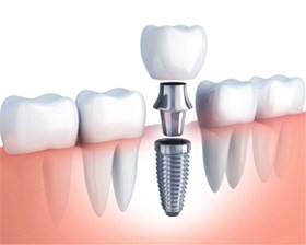 dental implant post with abutment and crown