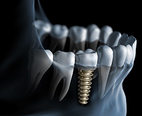 Model of implant supported dental crown