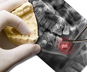 X-ray and model of wisdom tooth to be extracted