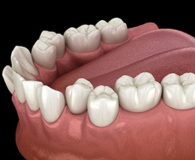 Illustration of crowded teeth