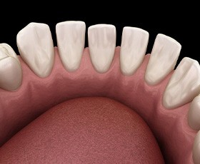 Illustration of gaps between teeth