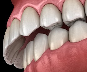 Illustration of overbite