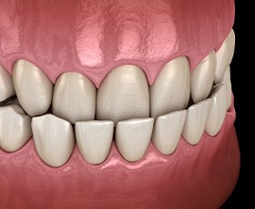 Illustration of underbite