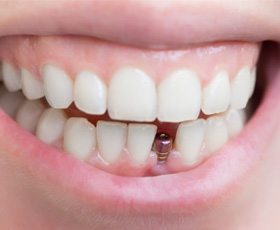 close-up of a person smiling with a visible dental implant abutment 