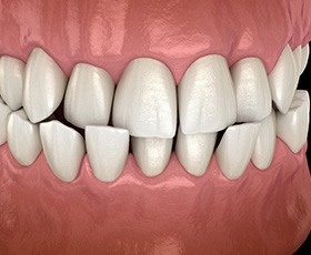 Illustration of crossbite