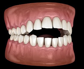 Illustration of open bite