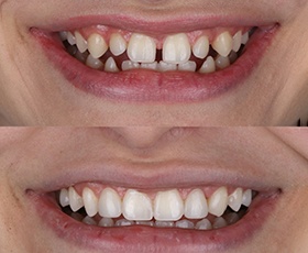 A smile before and after dental bonding