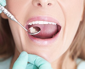 Closeup of smile during dental exam