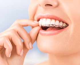 A woman holding a clear aligner