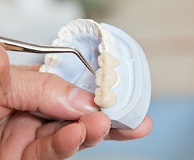 A dental lab technician creating a customized dental bridge that includes three fused dental crowns