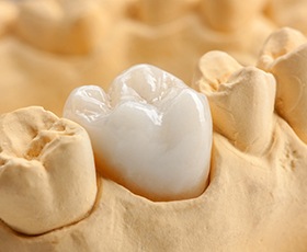 A mouth mold that shows healthy teeth along the bottom row and a custom-made dental crown sitting atop a weakened tooth