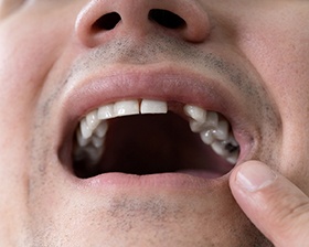 A closeup of a mouth with missing teeth