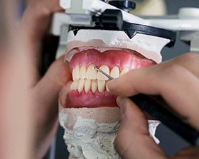 Dentures can be made of a variety of materials