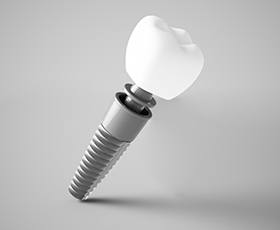 Closeup of a single tooth dental implant in Washington