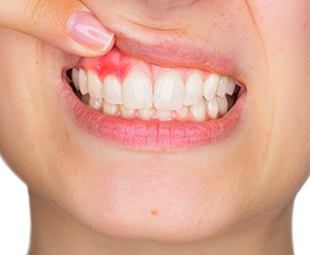 Closeup of smile with damaged gums