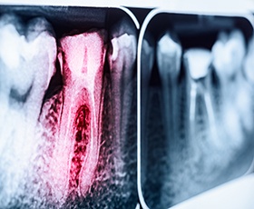 X-ray of root canal treated teeth