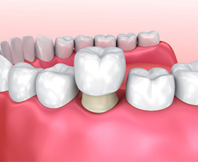 dental crown