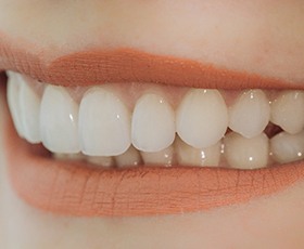 Closeup of woman smiling with veneers in Washington DC