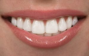 A closeup of a white smile.