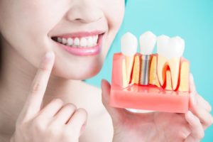 Dentist pointing to her smile while holding model of dental implants