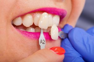 woman with veneers