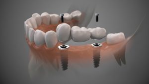 dental implants 3D illustration 