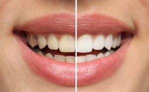 Teeth whitening before and after photo